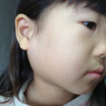 おたふく風邪   ムンプス